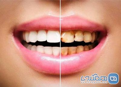 نقص مینای دندان چیست؟