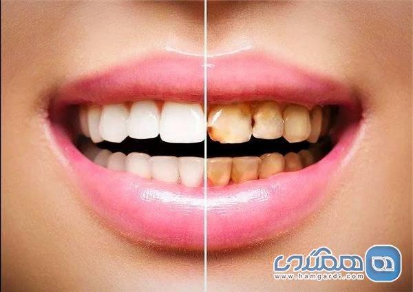 نقص مینای دندان چیست؟